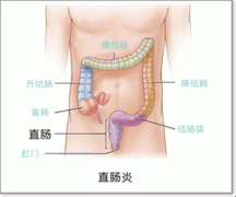 直肠炎示意图