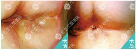 SFT肛泰方法(第三代HCPT)方法治疗肛周脓肿对比图