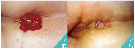 SFT肛泰方法(第三代HCPT)治息肉前后对比图