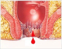 治便血什么方法不错