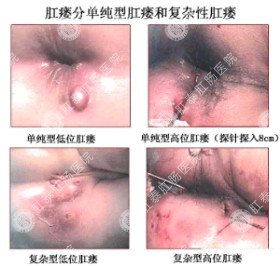 细数女性肛瘘的原因