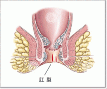 春节后女性肛裂便血的原因有哪些？