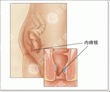 内痔会不会传染？