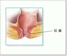 肛瘘手术费用