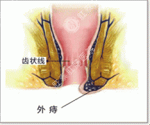 外痔出血的治疗需注意哪些？