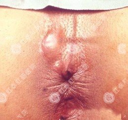 男人肛周脓肿怎么治疗？