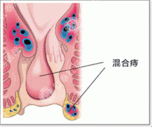 环状混合痔危害大怎么办？