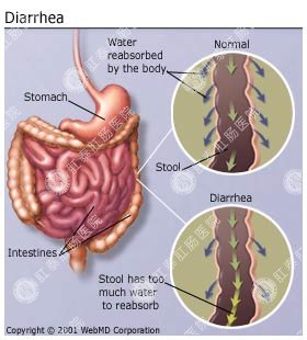 慢性腹泻是怎么回事？为何久治不愈？