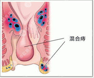 医博医院：混合痔什么症状？