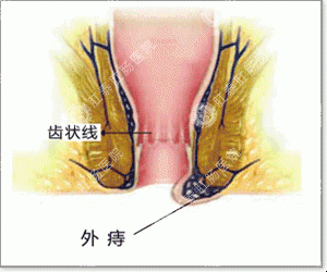 外痔疮可以用药治疗吗？治疗外痔疮用什么药好？