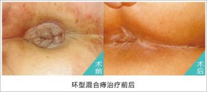 福州痔疮医院地址