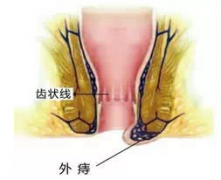 福州外痔疮医院哪家不错