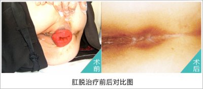 福州脱肛医院哪个好