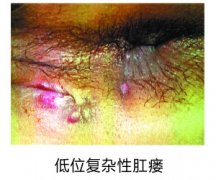 福州那家医院看肛瘘好