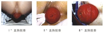 福州做脱肛要多少费用
