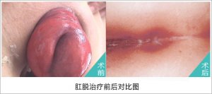 福州做脱肛要多少费用？