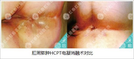 福州屁股肿了一块是怎么回事啊？