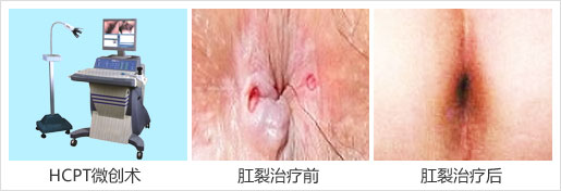 福州肛裂能吃醋吗