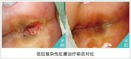 福州肛瘘可以挂内科嘛？