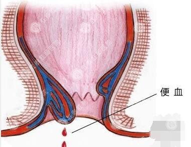 每次排便都有血是怎么回事呢 引起大便带血的原因？