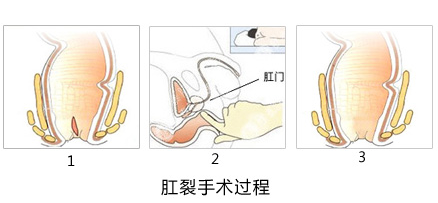 福州医博做肛裂手术多少钱?