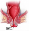 在福州治疗脱肛要花多少钱?