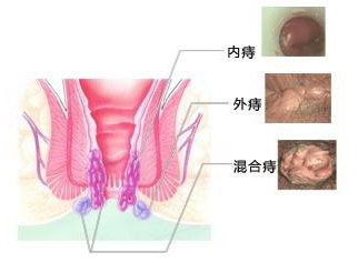 福州什么医院专业治痔疮?