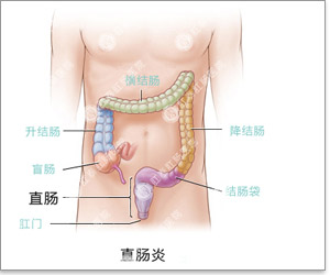 易被忽略的直肠息肉恶变