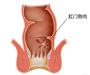 肛门息肉原因有哪些