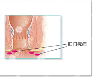 肛门疣病的危害