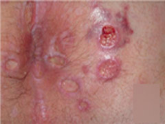 肛门湿疹有哪些危害