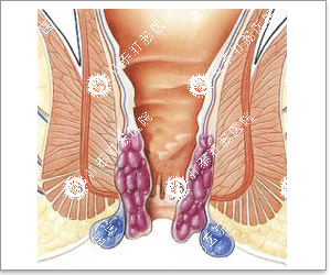 为什么会得外痔呢