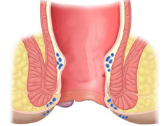 外痔疮的危害