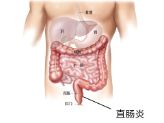 直肠炎的治疗和危害有哪些