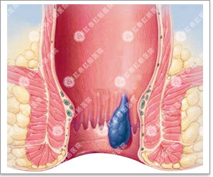 肛门出现异物是什么病
