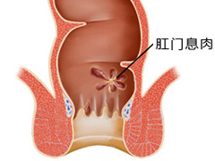 直肠炎的症状有哪些？直肠炎如何治疗？