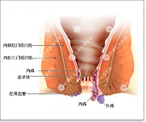 外痔的原因是什么