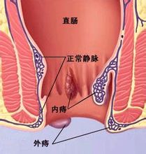 福州医博肛肠医院