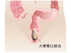 大便困难会引起哪些疾病