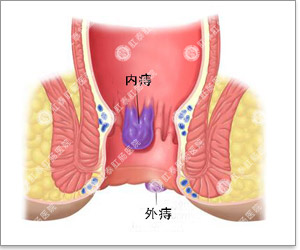 得了内痔该怎么办好