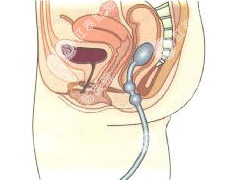 肛门有异物感是什么原因