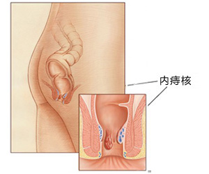 内痔疮治疗不错方法