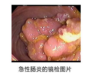 急性肠炎