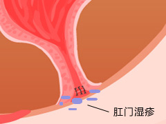 肛门湿疹有哪些危害呢？