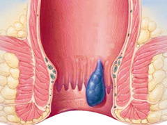 肛门异物具体是什么？