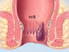 内痔疮怎么治