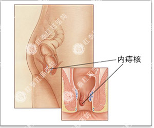 怎么判断得了内痔疮