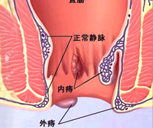 痔疮